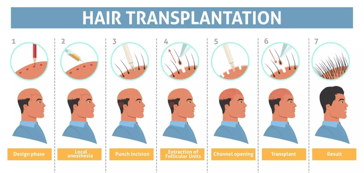 Hair Transplant before and after result at Abhirachna Dental, South Extension