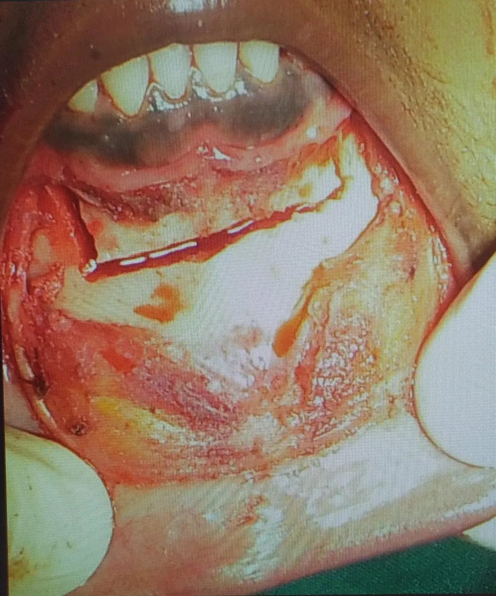Lower Segment Osteotomy at Abhirachna Dental, South Extension
