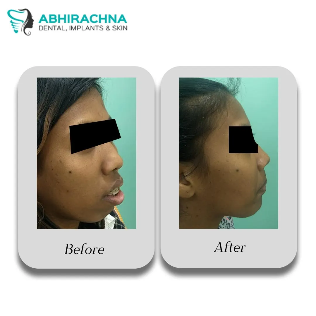 Mandibular Surgery before and after result at Abhirachna Dental, South Extension