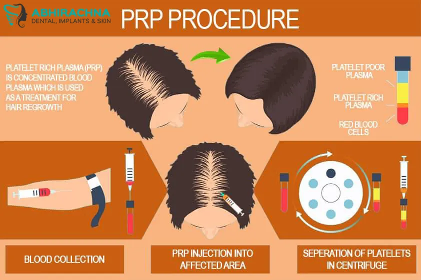 PRP for Hair before and after result at Abhirachna Dental, South Extension