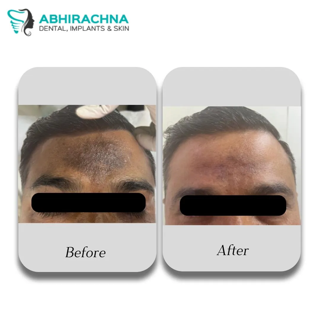 PRP for Face before and after result at Abhirachna Dental, South Extension - image 2