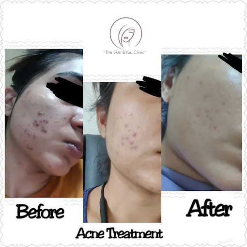PRP for Face before and after result at Abhirachna Dental, South Extension - image 1
