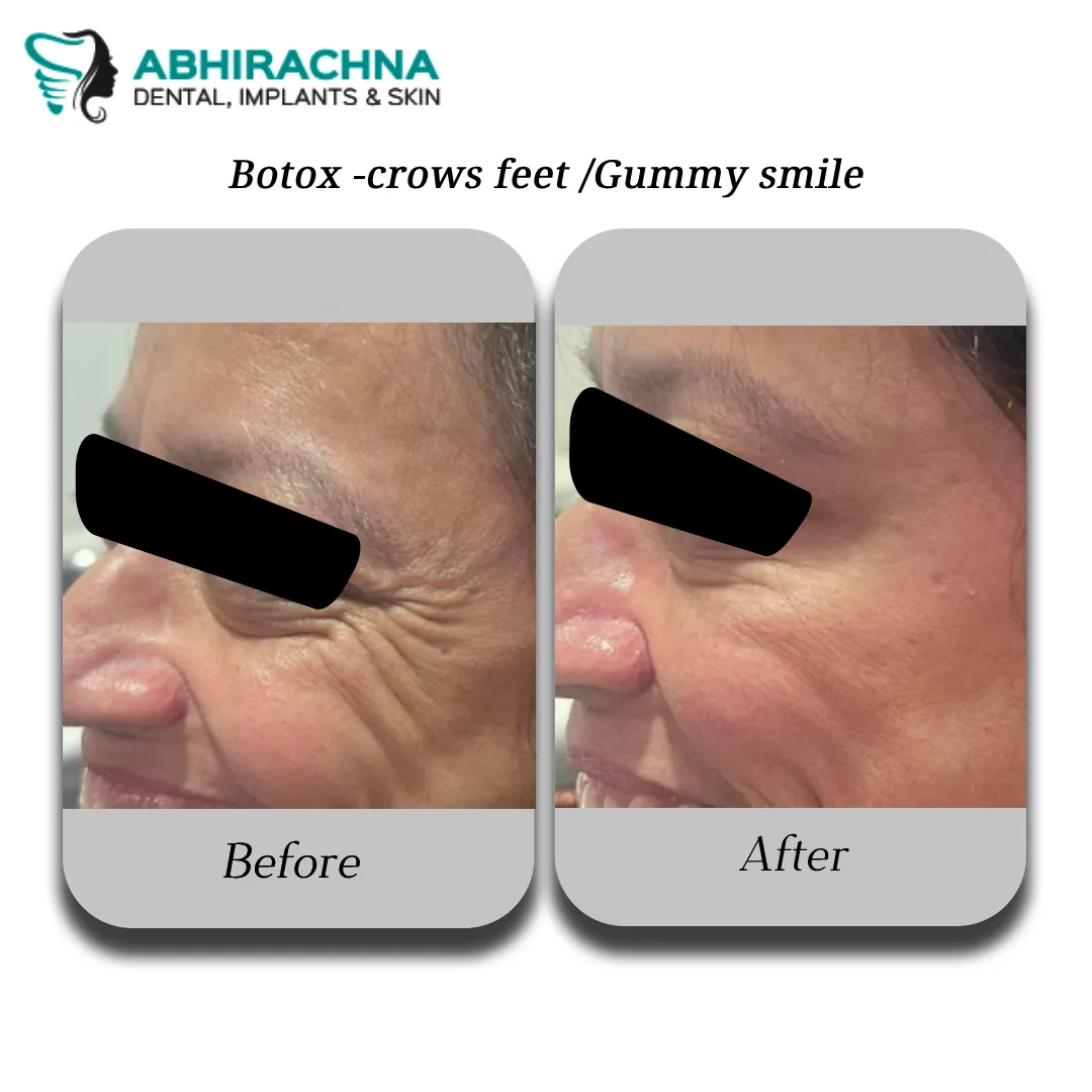 Anti Aging treatment at Abhirachna Dental, South Extension