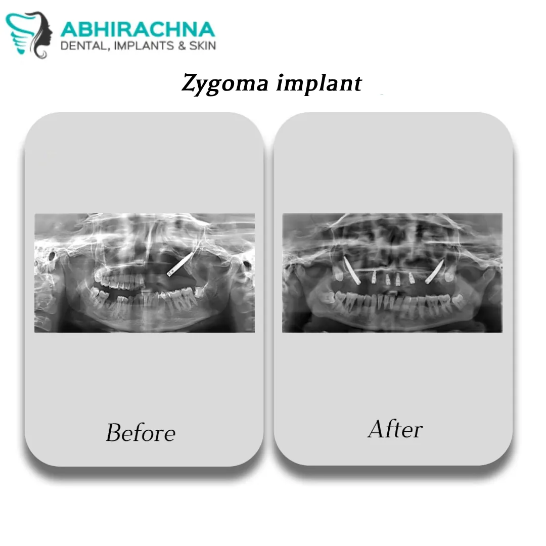 Zygoma Implant before and after result at Abhirachna Dental, South Extension - image 1