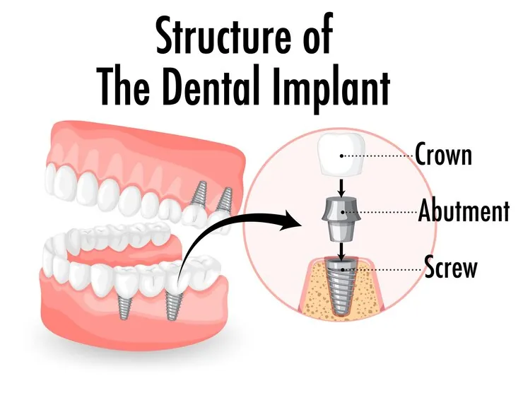 Best Dental Implant in New Delhi: A Comprehensive Guide