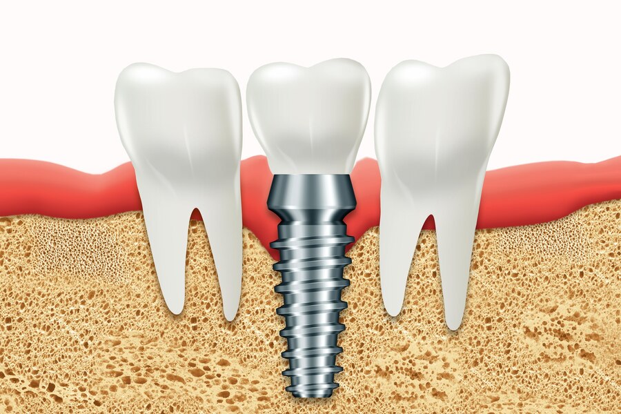 How to Find the Best Dentist for Single Teeth Implants in South Extension Part 1?