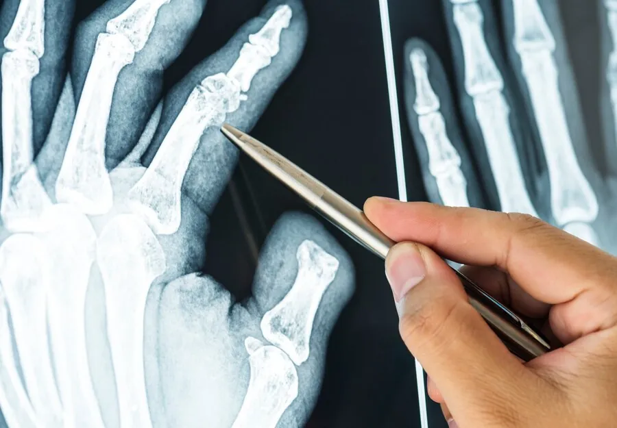 Is Bone Grafting Treatment Painful? What Can I Expect During Recovery with Dr. Abhishek Bhardwaj?