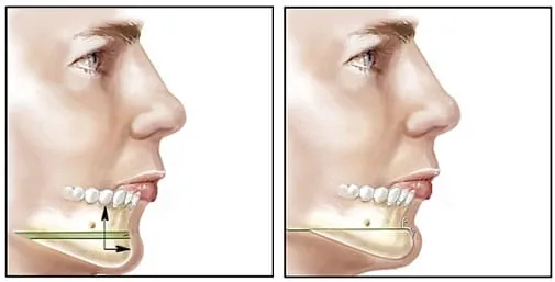Genioplasty Surgical treatment at Abhirachna Dental, South Extension