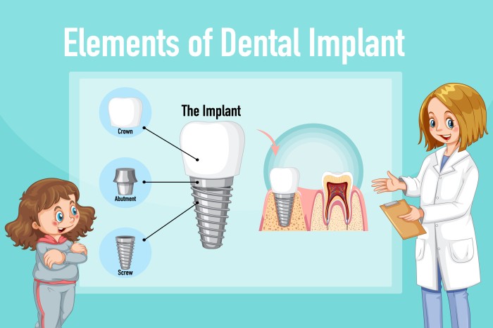 Who is the Best Nobel Active Implants Clinic in South Extension Part 1