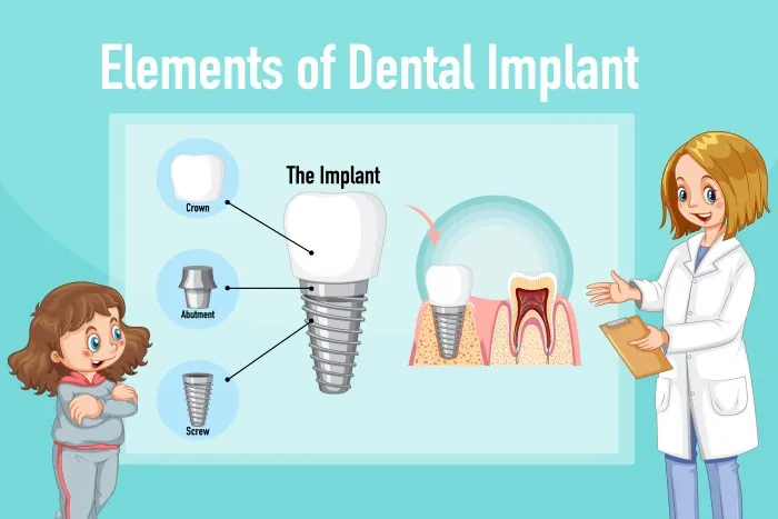 Who is the Best Nobel Active Implants Clinic in South Extension Part 1