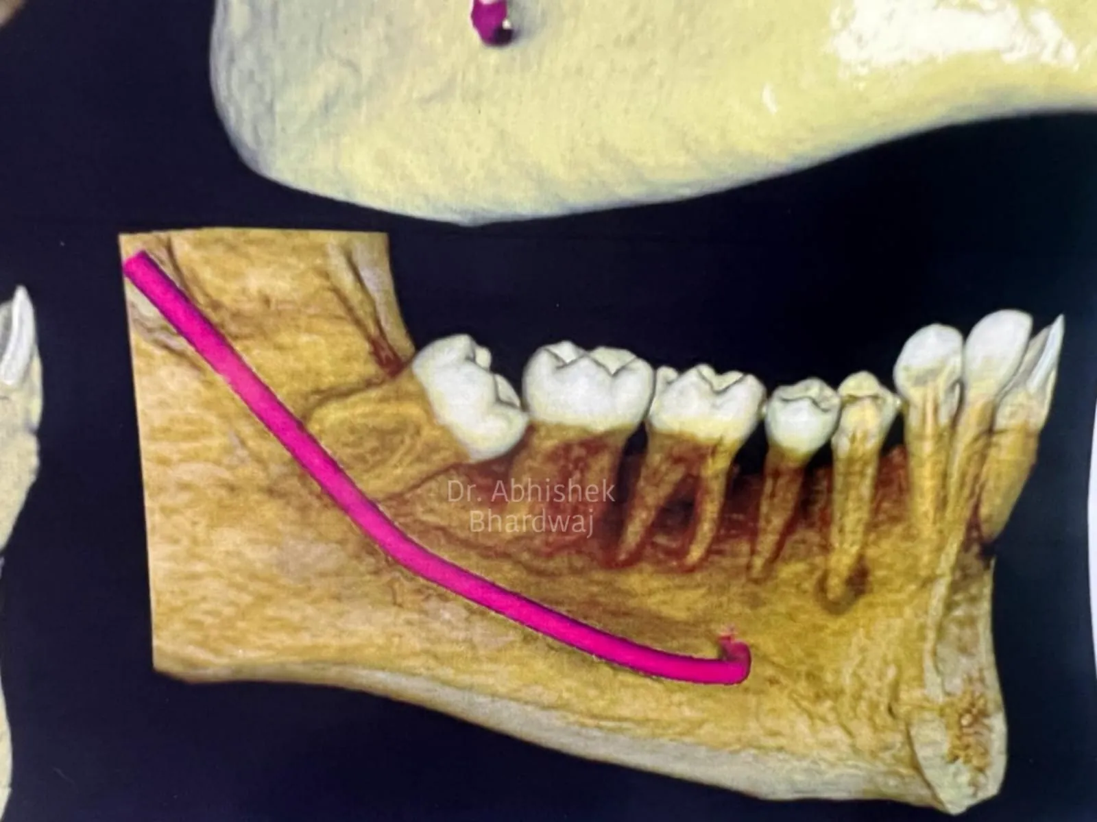 How to Find the Best Dentist for Wisdom Teeth Surgery in South Extension Part 1?
