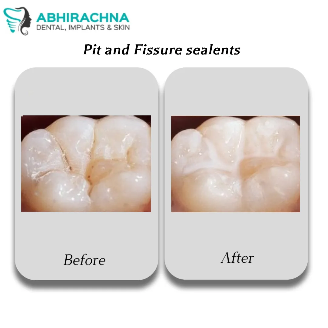 Why Are Pit & Fissure Sealants Important for Children in South Extension 1?