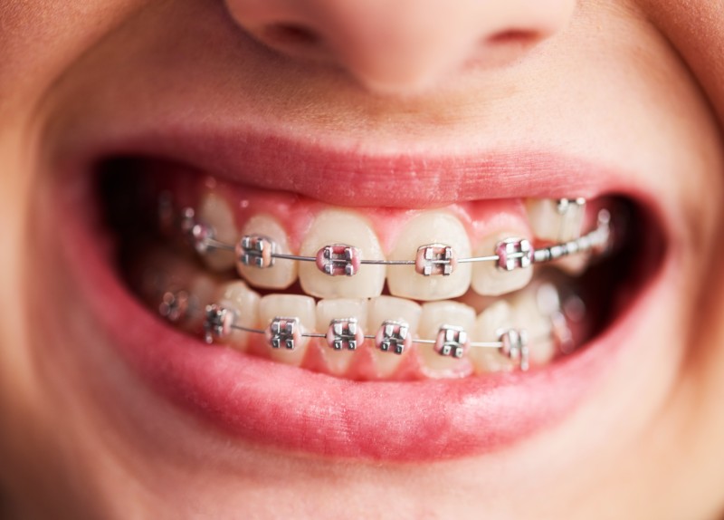Which Are the Best Ceramic Braces for Teeth in South Extension I?