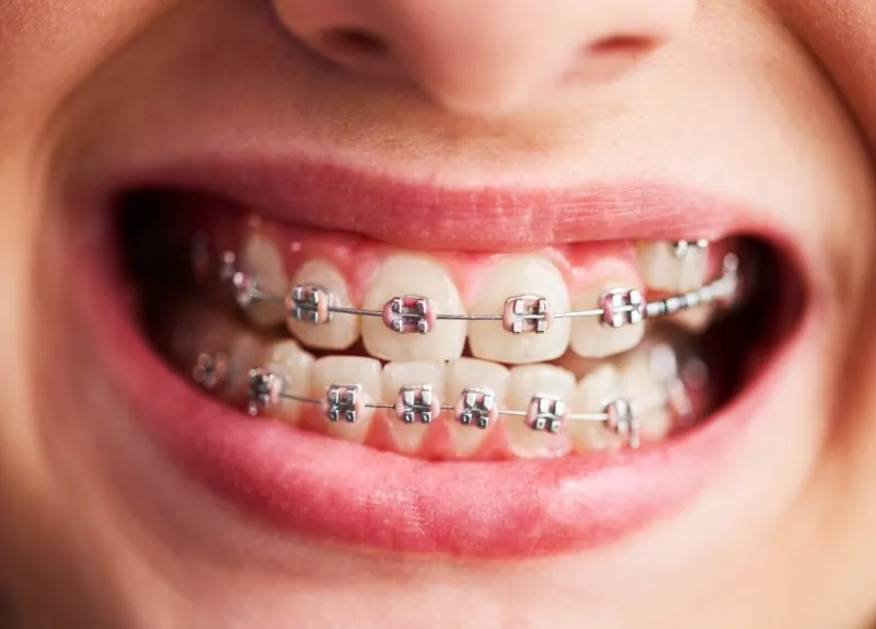 Which Are the Best Ceramic Braces for Teeth in South Extension I?