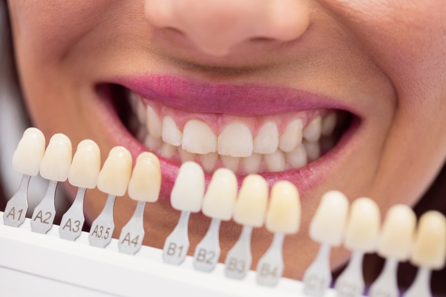 How to Find the Best Teeth Laminate Treatment in South Extension 1 for a Perfect Smile?