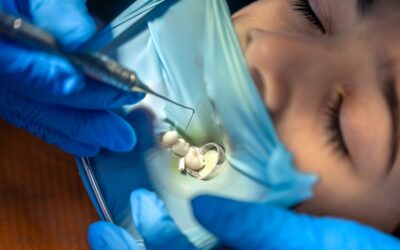 Which Clinic Offers the Best Dental Pit & Fissure Sealants Treatment in South Extension?