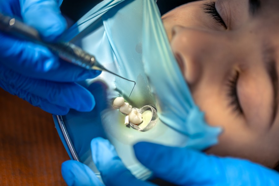 Which Clinic Offers the Best Dental Pit & Fissure Sealants Treatment in South Extension?