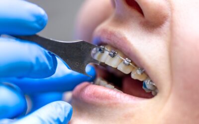 How to Find the Best Teeth Alignment Treatment in South Delhi for Crooked Teeth?