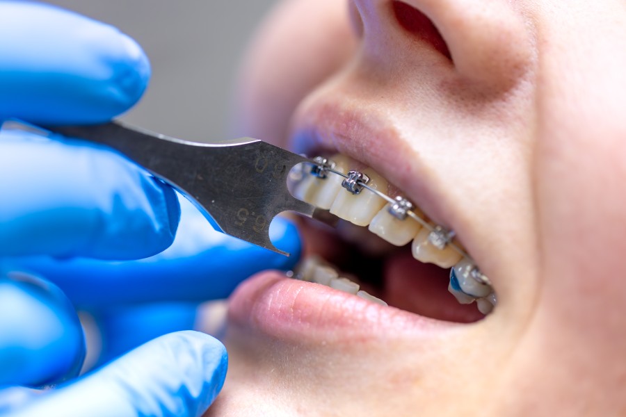 How to Find the Best Teeth Alignment Treatment in South Delhi for Crooked Teeth?