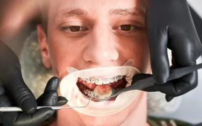 What Are the Common Signs That You May Need Teeth Alignment Treatment?