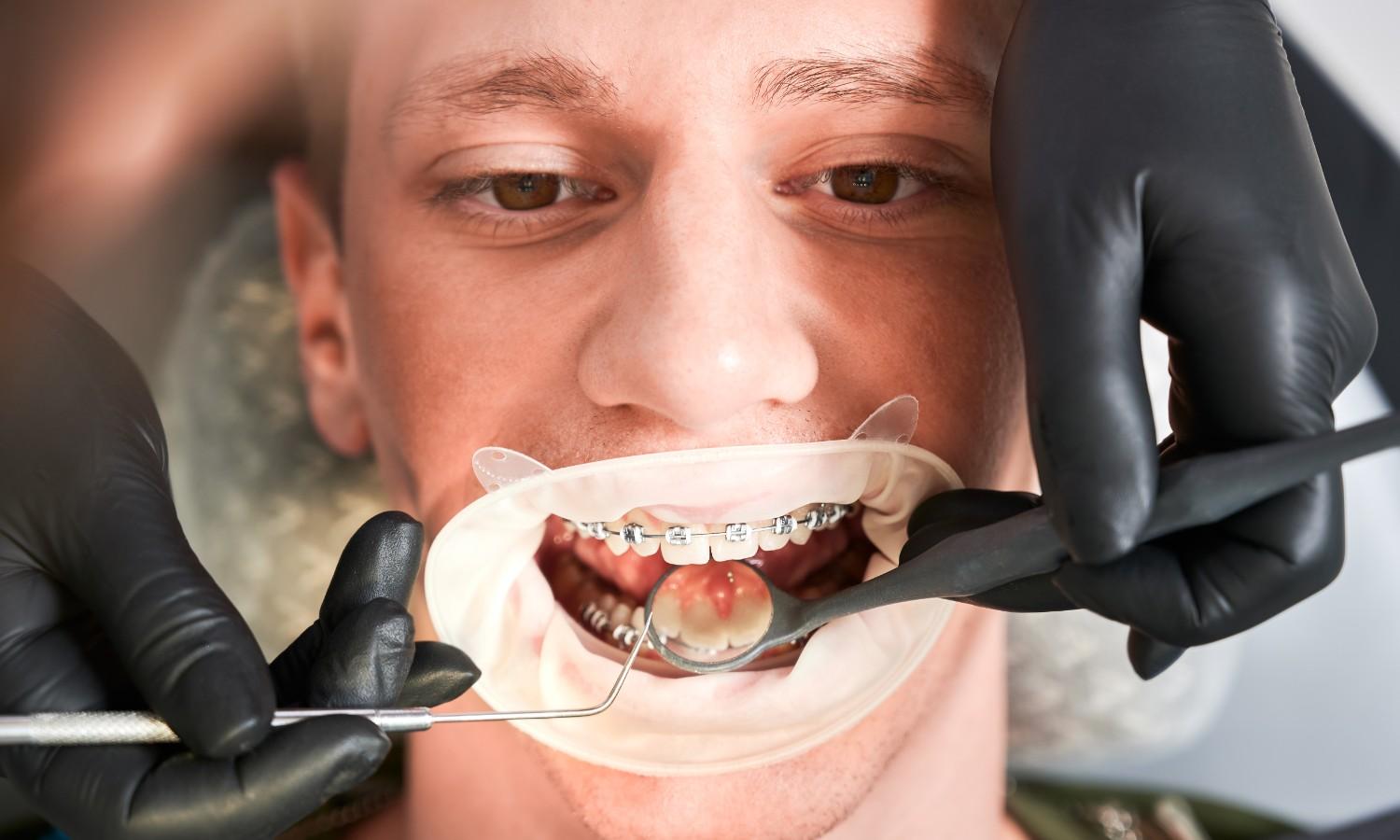 What Are the Common Signs That You May Need Teeth Alignment Treatment?