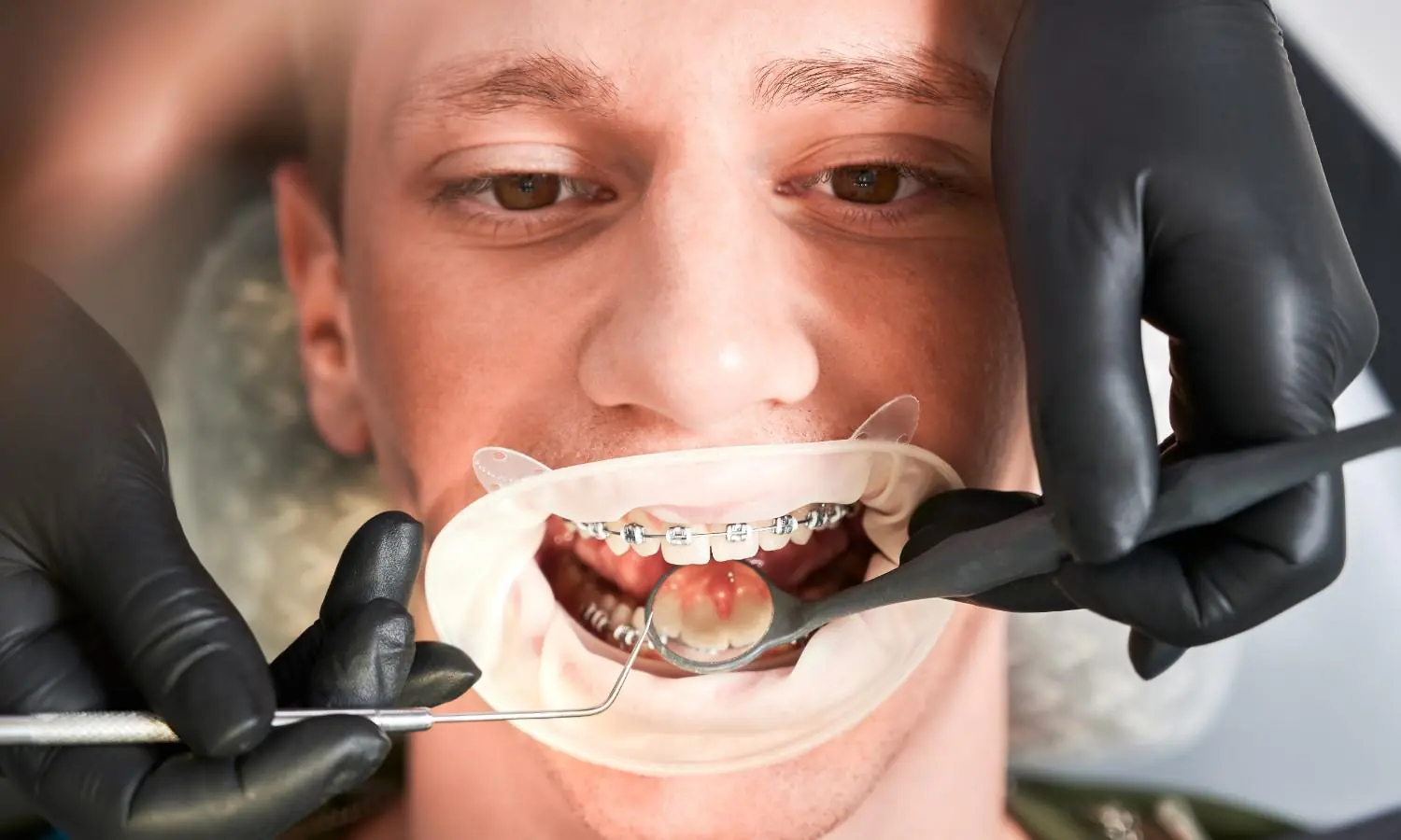 What Are the Common Signs That You May Need Teeth Alignment Treatment?